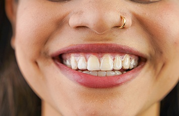 Closeup of barely visible clear aligner over woman’s teeth
