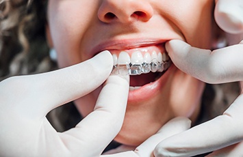 Closeup of dentist checking the fit of patient’s Invisalign
